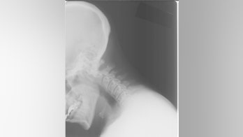 Child's rare injury: What's internal decapitation?