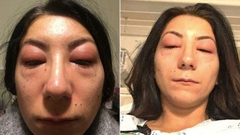Woman warns others about eyelash extension dangers after severe allergic reaction