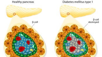 Long-sought 'attack' signal in type 1 diabetes identified