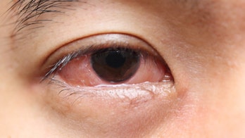 10 reasons your eyes are bloodshot
