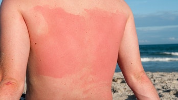 The best home remedies for sunburn