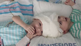 Mother of twins conjoined at head holds son for first time
