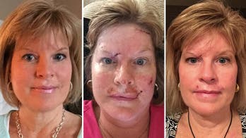 Woman shares skin cancer photos to show effects of tanning habit