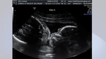 Ultrasound shows twins kissing in mother's womb
