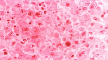 Rare West African virus confirmed in Minnesota traveler, search on for others exposed