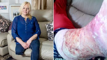 Woman has leg amputated after infection from shaving cut