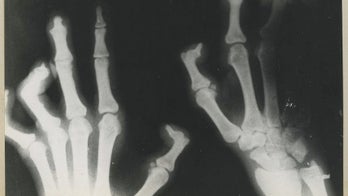 Leprosy suspected in 2 California kids: How could they contract it?