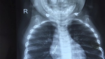Doctors discover small light bulb inside a child after coughing fit