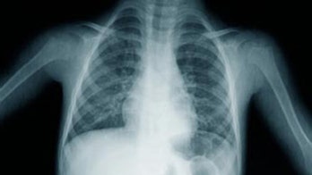 X-Ray Lung Cancer Screening Does Not Prevent Deaths