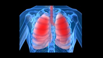 Sleep apnea may increase risk of pneumonia, study says