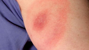 Mystery solved: How Lyme disease bacteria spread around the body
