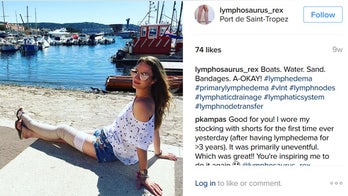 Model raising awareness of rare condition that caused leg to double in size