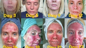 These graphic photos of skin precancer treatment are a must-see