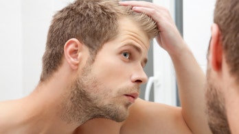 What's 'invisible baldness'? 6 warning signs you may be at risk