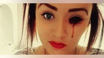 17-year-old who bleeds from eyes baffles doctors