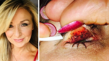 Mascara kept on for decades leaves 'embedded' lumps under woman's eyelids