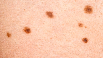 Woman sprouts thousands of tiny moles, and doctors aren't sure why