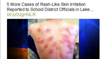 Students at California school develop mysterious rash