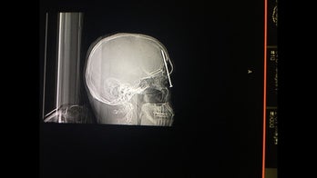 Home builder recovering after accidentally firing nail gun into head