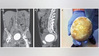 Man's bladder stone was almost as big as an ostrich egg