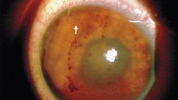 Parasitic worm squirms through teen's eye, damaging his vision