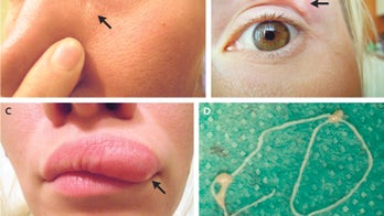 'Migrating' bumps on woman's face discovered to be parasite