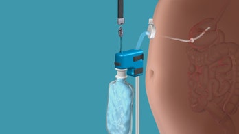 FDA approves stomach-draining obesity treatment