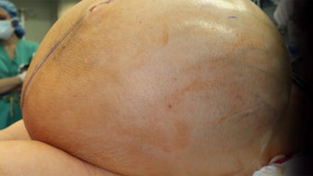 Woman has 132-pound ovarian cyst removed