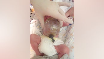 Giant omphalocele: What every parent should know about this rare birth defect