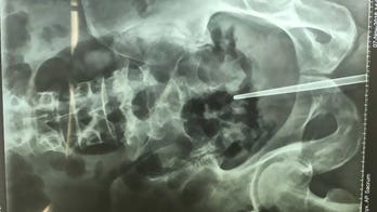 Man gets chopstick lodged in penis