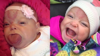 Baby born with enlarged tongue smiles for first time