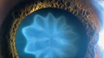 Flower-shaped cataract forms in man's eye after bike accident