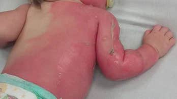 Arizona baby left with second-degree burns after being sprayed by hose