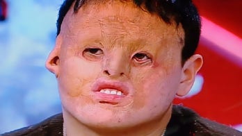 Surgeons use skin from patient's stomach in life-changing face transplant