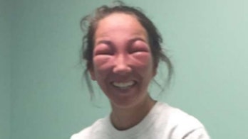 Photos of Connecticut woman with poison ivy in her eyes go viral