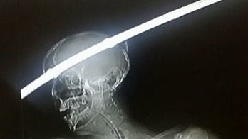 Car accident victim survives having head impaled by metal rod