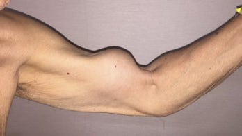 Why a man's arm looks like Popeye's
