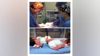 58-year-old woman gives birth to twins in Mexico