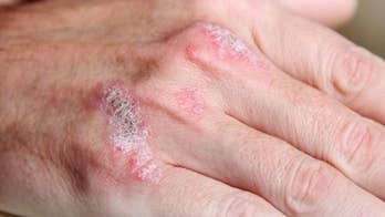 Skin condition linked to risk of aneurysm
