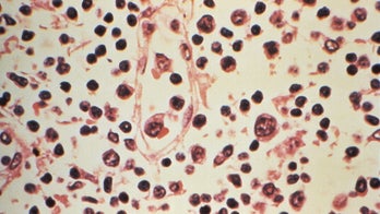 Man contracts hantavirus after staying in cabins at California park, family says