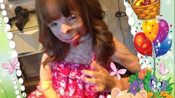 New York girl who lost family in fire gets new hand, foot