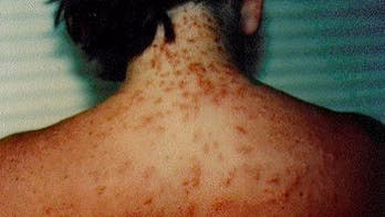 Florida Panhandle beachgoers warned of stinging sea lice