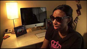 Georgia woman’s rare reaction to medication caused skin, hair to peel off