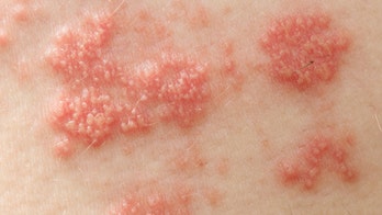 Shingles linked to increased risk of heart attack, stroke