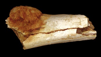 Oldest cancer in human ancestor found in 1.7-million-year-old bone