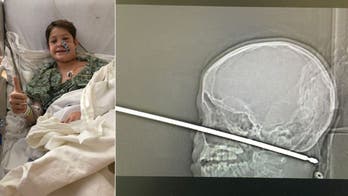Missouri boy, 10, survives being impaled in the face by a metal meat skewer