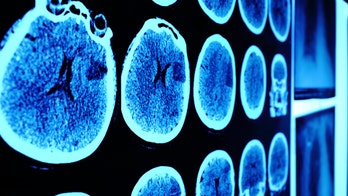 Woman's potentially fatal brain condition was misdiagnosed as allergies