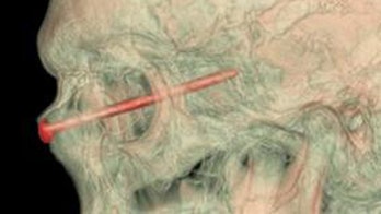 Landscaper has 3-inch nail removed from eye