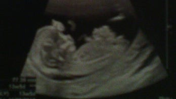 Ultrasound reveals baby's organs growing outside body