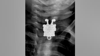 Surprise, it's SpongeBob! X-Ray shows what toddler swallowed